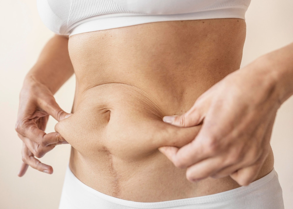 Can I Have a Tummy Tuck After A C-Section?