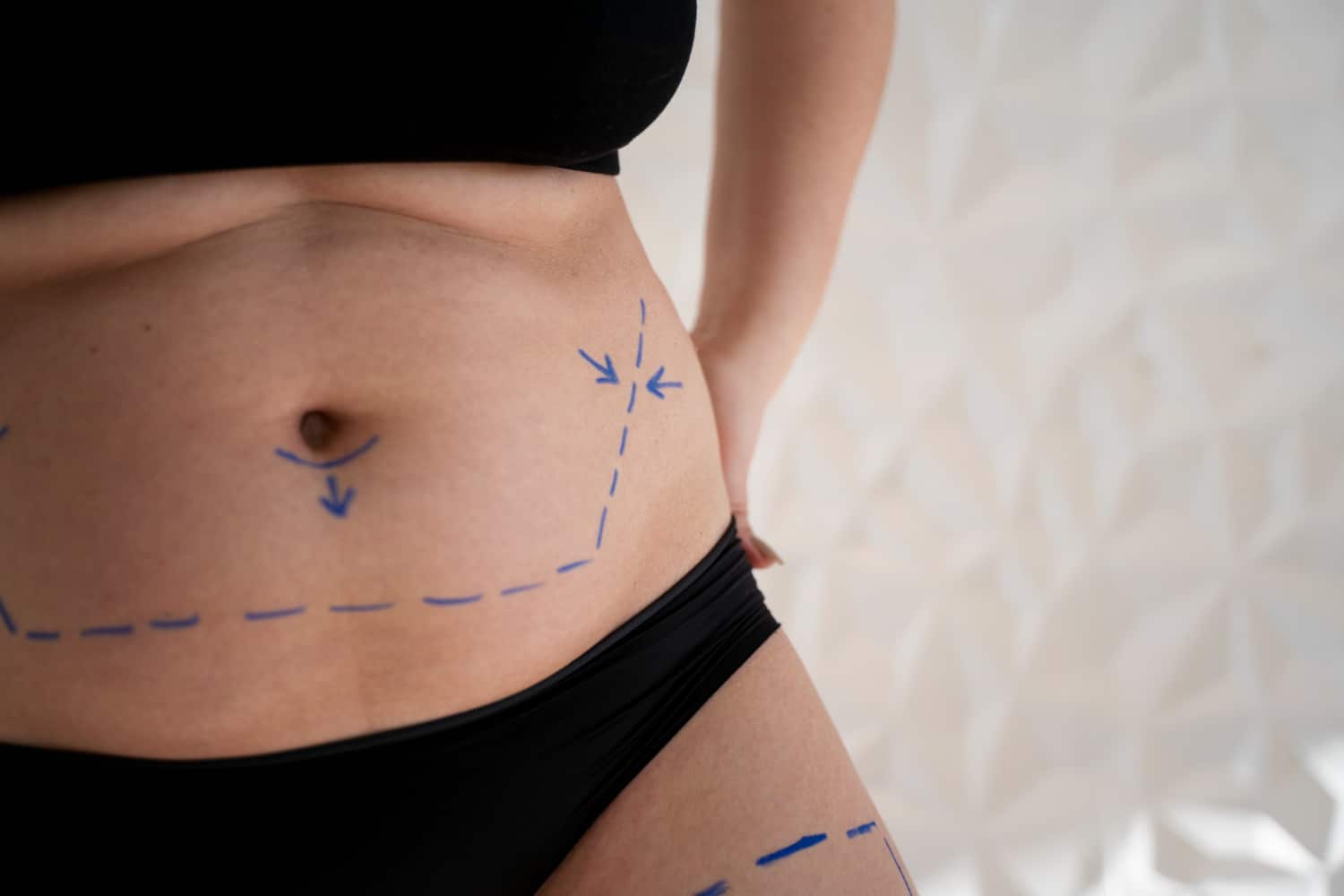 Liposuction for Different Body Areas: Targeting Stubborn Fat