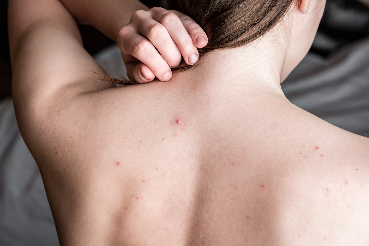 Does a Hydrafacial Treat Back Acne and the Body?