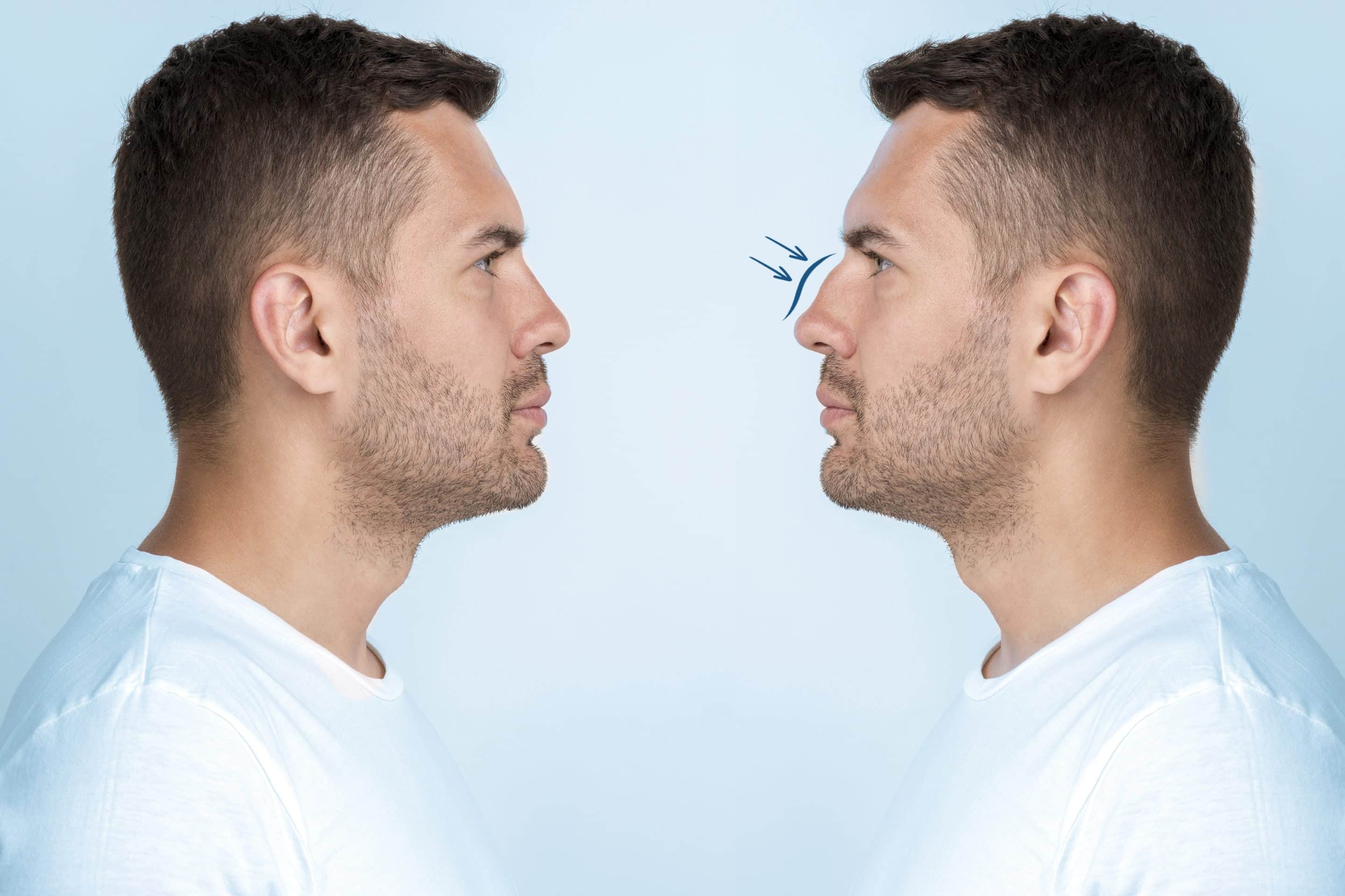 Male rhinoplasty - what is it, what's the difference and what's involved?