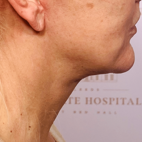 Everything You Need to Know About Neck Lift Surgery