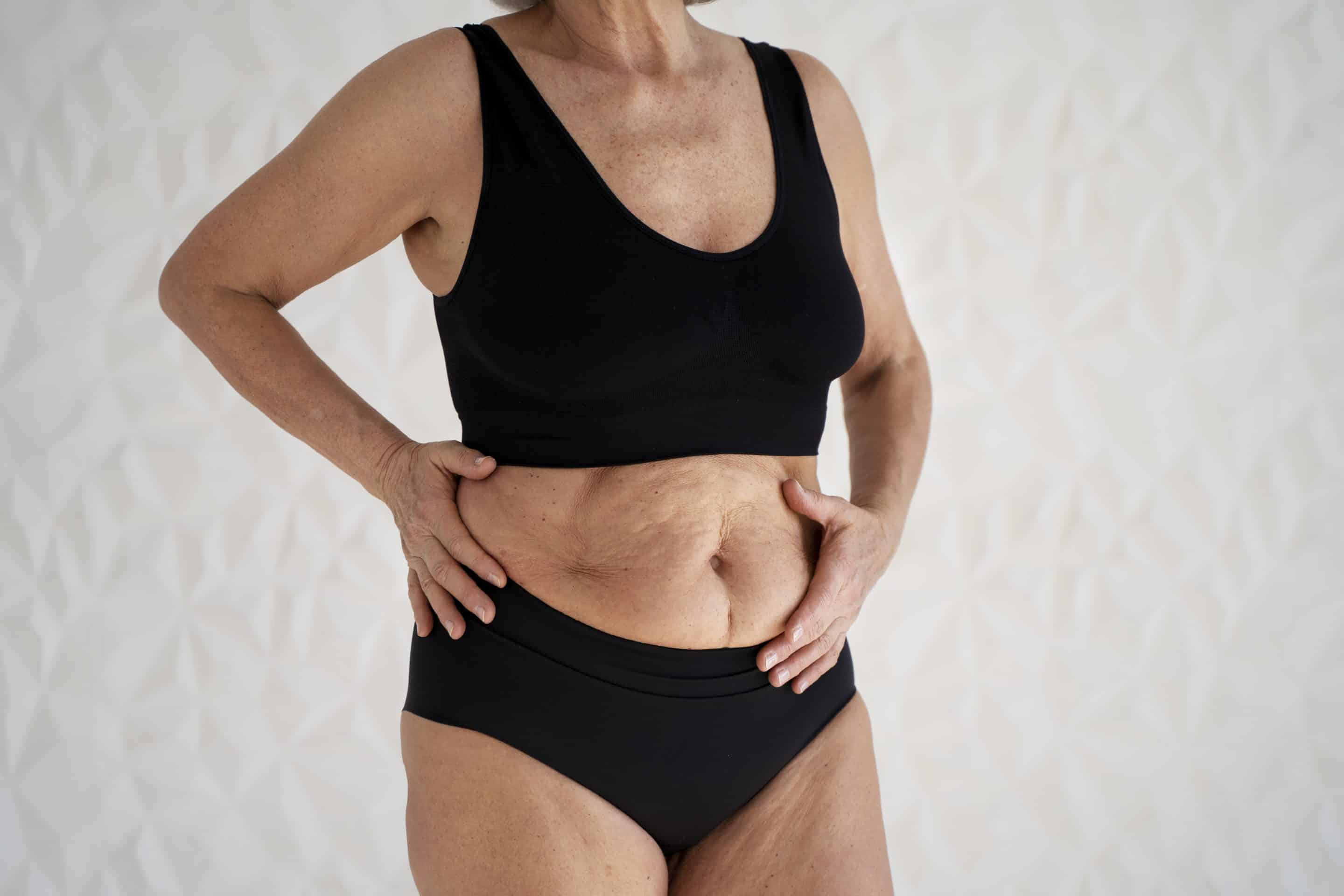 Things to Consider Before a Liposuction Operation