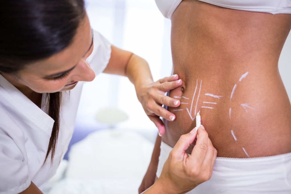 Should I get a tummy tuck?